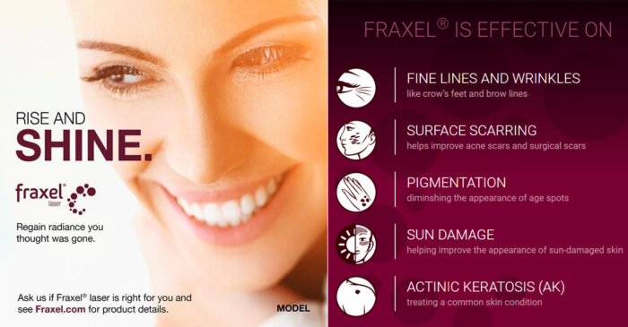 Fraxel laser treatment